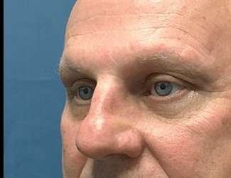 Blepharoplasty Before & After Patient #2282