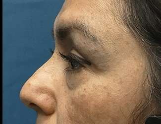 Blepharoplasty Before & After Patient #2293