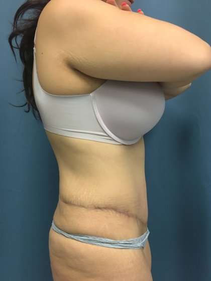 Tummy Tuck Before & After Patient #439