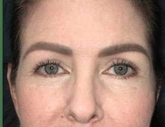 Blepharoplasty Before & After Patient #2315