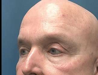 Blepharoplasty Before & After Patient #2328