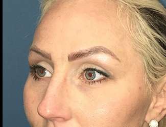 Blepharoplasty Before & After Patient #2339