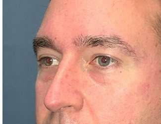 Blepharoplasty Before & After Patient #2352