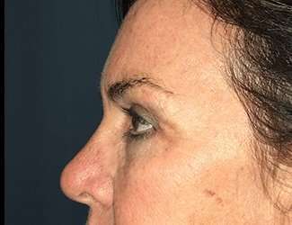 Blepharoplasty Before & After Patient #2368