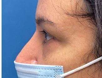 Blepharoplasty Before & After Patient #2385