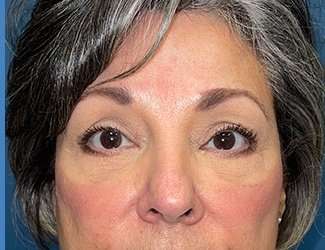Blepharoplasty Before & After Patient #2397