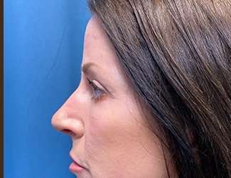 Blepharoplasty Before & After Patient #2408
