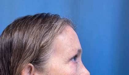 Blepharoplasty Before & After Patient #2419