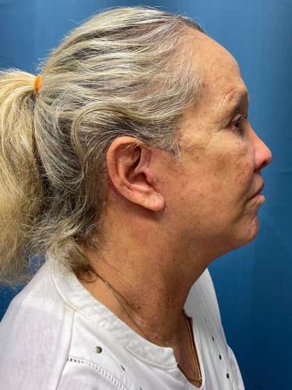 Blepharoplasty Before & After Patient #2430