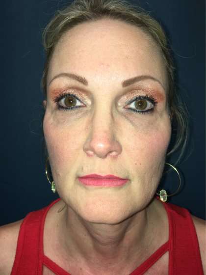 Blepharoplasty Before & After Patient #2437