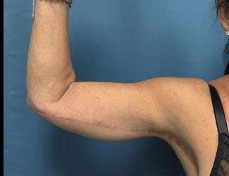 Arm Lift Before & After Patient #2461