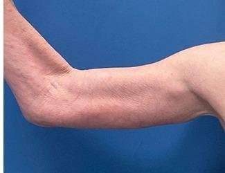Arm Lift Before & After Patient #2473
