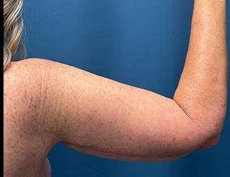 Arm Lift Before & After Patient #2482