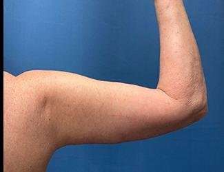 Arm Lift Before & After Patient #2491