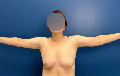 Arm Lift Before & After Patient #2498