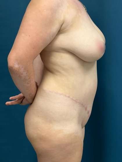 Tummy Tuck Before & After Patient #271