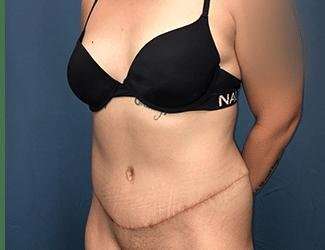 Tummy Tuck Before & After Patient #457
