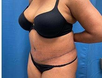 Tummy Tuck Before & After Patient #468