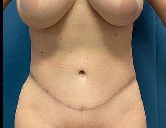 Tummy Tuck Before & After Patient #475