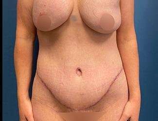 Tummy Tuck Before & After Patient #482