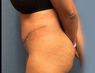 Tummy Tuck Before & After Patient #504
