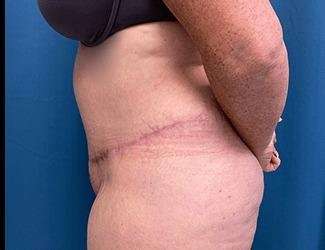 Tummy Tuck Before & After Patient #515