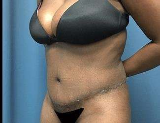 Tummy Tuck Before & After Patient #528