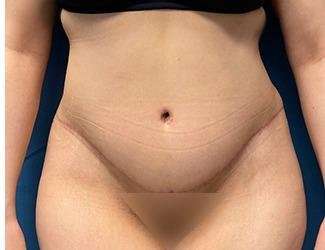 Tummy Tuck Before & After Patient #535