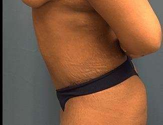 Tummy Tuck Before & After Patient #546