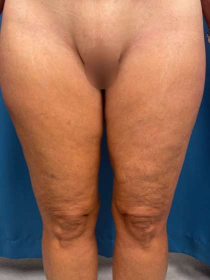 Thigh Lift Before & After Patient #553