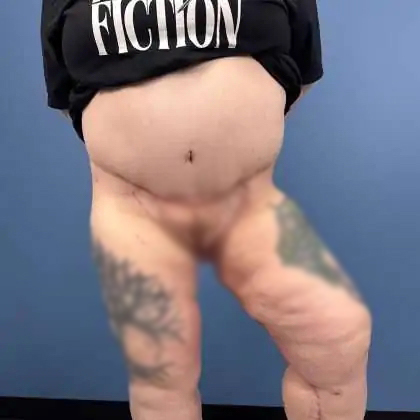 Massive Weight Loss Before & After Patient #995