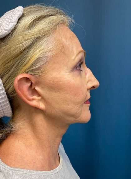 Submentoplasty Before & After Patient #654