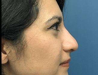 Rhinoplasty Before & After Patient #667