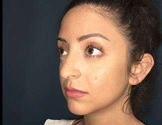 Rhinoplasty Before & After Patient #680