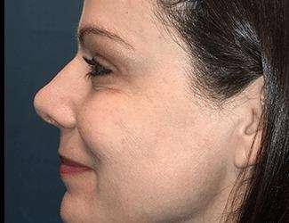Rhinoplasty Before & After Patient #693