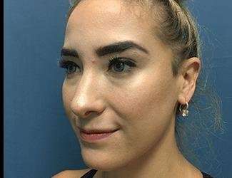 Rhinoplasty Before & After Patient #706