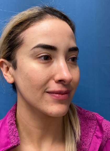 Rhinoplasty Before & After Patient #715