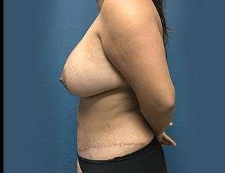 Mommy Makeover Before & After Patient #743