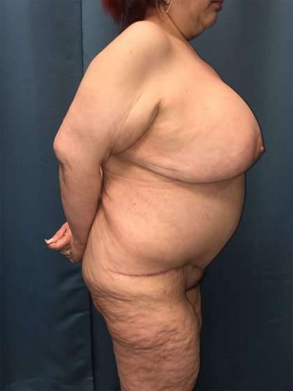 Mommy Makeover Before & After Patient #893
