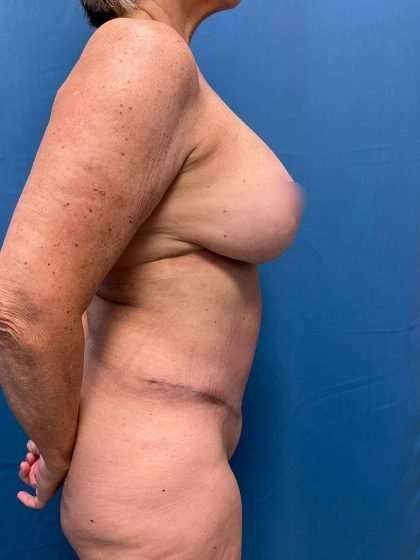 Tummy Tuck Before & After Patient #311
