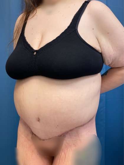 Massive Weight Loss Before & After Patient #986