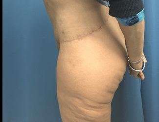 Lower Body Lift Before & After Patient #1047