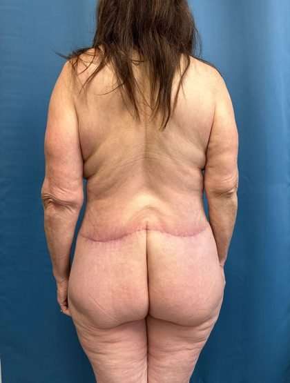 Lower Body Lift Before & After Patient #1063