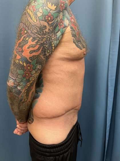 Tummy Tuck Before & After Patient #322