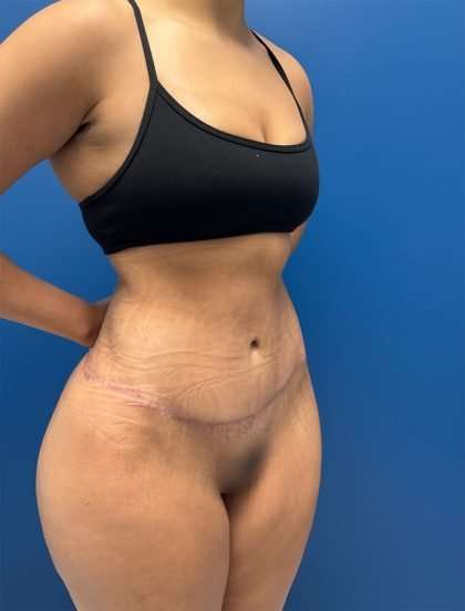 Lower Body Lift Before & After Patient #1081
