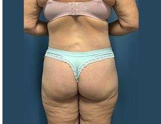 Lower Body Lift Before & After Patient #1101