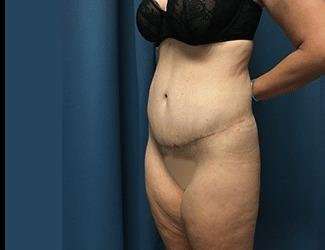 Lower Body Lift Before & After Patient #1114