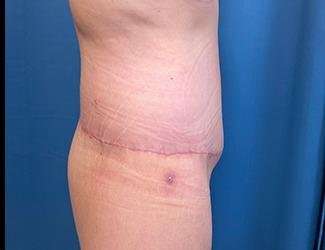 Lower Body Lift Before & After Patient #1127