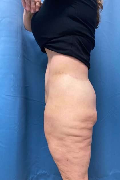 Lower Body Lift Before & After Patient #1174