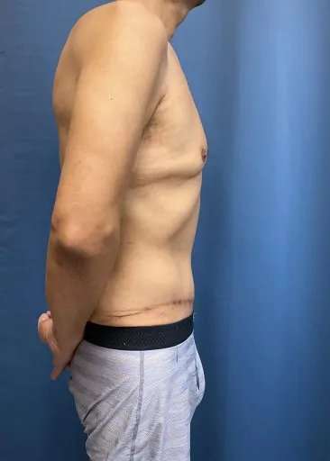 Tummy Tuck Before & After Patient #333